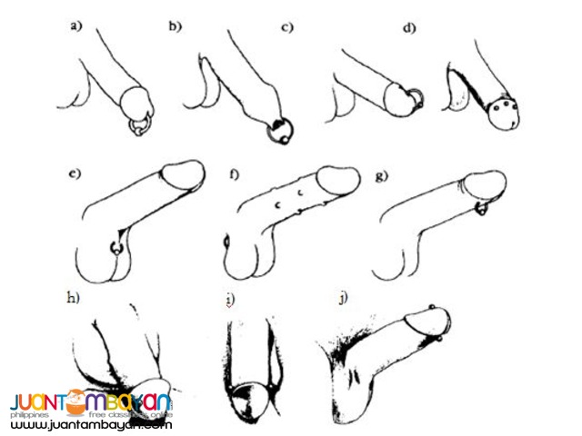 Penile Implant Removal (Beads, Pearls, Bolitas, etc)