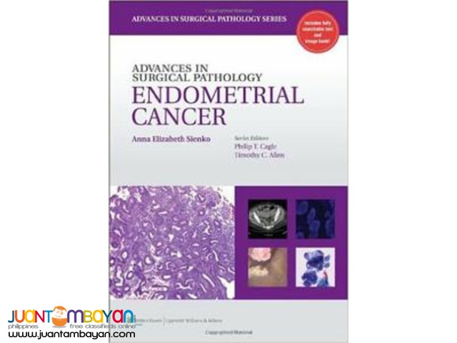 Advances in Surgical Pathology: Endometrial Carcinoma Advances in Surgical Pathology: Endometrial Carcinoma