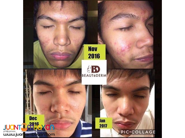 Beautederm Regular Set / Facial Set / Anti-pimple Set