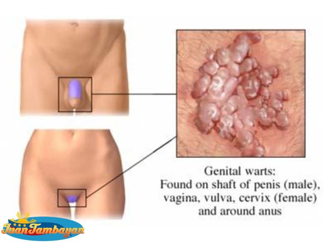 Genital Warts Removal (done by MD)