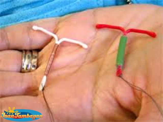 IUD insertion